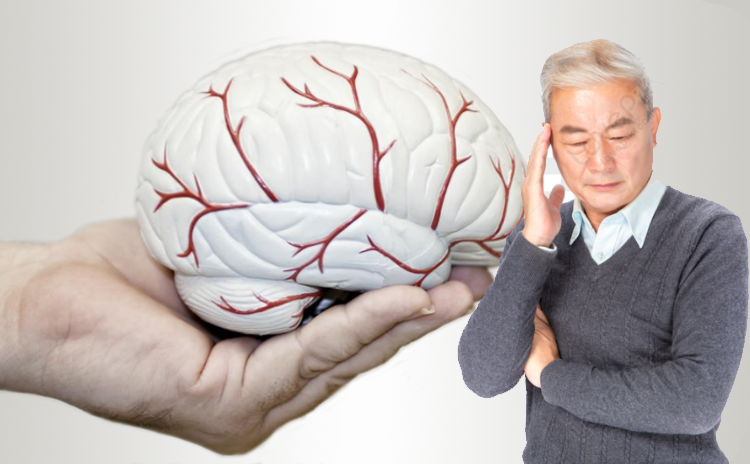 Thiểu năng tuần hoàn não: Nguyên nhân, triệu chứng, chẩn đoán và điều trị